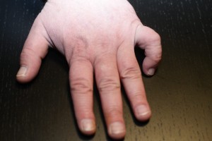 Bruderschaft des verkrüppelten Fingers